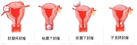 子宫肌瘤多大算严重，子宫肌瘤的危害有哪些